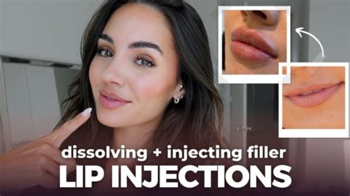 Shock of the CenturyKylie Jenner Finally Admits to Getting Lip Injections